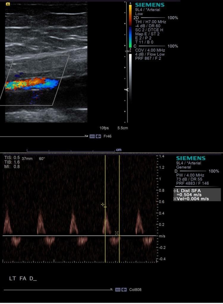 This composite image displays a lower extremity arterial duplex ultrasound of the left superficial femoral artery (SFA). The top panel features a color flow Doppler image of the distal SFA, showing a heterogeneous mosaic color pattern (mixture of red, blue, and yellow) within the lumen. This color aliasing and turbulence are indicative of localized high-velocity flow, consistent with arterial stenosis. The bottom panel presents a spectral Doppler waveform analysis of the same segment. The waveform is triphasic, characterized by a sharp systolic peak, a brief period of early diastolic flow reversal, and a small late diastolic forward component. Quantitative measurements indicate a peak systolic velocity (PSV) of 0.504 m/s. The ultrasound is used to evaluate peripheral arterial disease (PAD) and assess the degree of luminal narrowing in the lower extremity vasculature. Key educational points include the recognition of turbulent flow patterns on color Doppler and the interpretation of spectral waveforms in the context of arterial resistance.