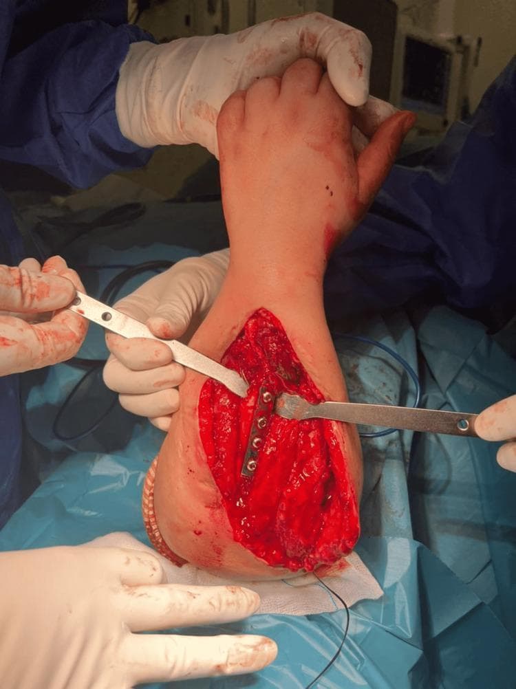 Intraoperative clinical photograph showing a single-bone forearm reconstruction. The image depicts a surgical field with an extensive longitudinal incision on the forearm. A metallic compression plate is positioned across an osteotomy site, fixating the remaining proximal ulna to the distal radius with five visible bicortical screws. The surrounding anatomy shows exposed red muscle tissue and retracted skin edges held by surgical retractors. The hand and digits are visible at the top of the frame, showing some blood staining typical of an active procedure. This visual demonstrates an osteosynthesis technique used for salvage or reconstructive procedures, such as those necessitated by hereditary multiple exostoses. The orientation shows a distal-to-proximal alignment intended to restore forearm stability and axial alignment. Blue surgical drapes and gloved hands are visible, highlighting the sterile operative environment.