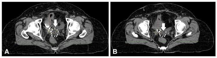 This diagnostic image displays two axial CT scan slices (A and B) of the female pelvic region, illustrating the placement of interstitial brachytherapy equipment for the treatment of cervical cancer. The images demonstrate the anatomical context of the central pelvis, including the pelvic girdle bones, gluteal musculature, and internal viscera. White arrows in both panels highlight numerous hyperdense (bright white), small, metallic points distributed within the soft tissue of the vaginal vault and cervical region. These represent interstitial needles and a Kelowna applicator used to deliver targeted radiation doses. The needles are arranged in a structured array to conform to the residual tumor volume. Panel A shows a slightly higher axial section than Panel B, both emphasizing the proximity of the radioactive source delivery system to the bladder (anteriorly) and rectum (posteriorly), which are critical organs at risk during gynecological brachytherapy planning.