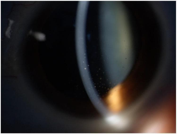 This clinical photograph displays the anterior segment of a human eye under slit-lamp examination, highlighting signs of viral anterior uveitis. The primary diagnostic feature shown is a collection of keratic precipitates (KPs) on the corneal endothelium. These KPs exhibit a mixed morphology, consisting of larger, discrete, coin-shaped deposits characteristic of cytomegalovirus (CMV) infection, interspersed with smaller, star-like stellate KPs often associated with Rubella virus (RV) or Fuchs heterochromic iridocyclitis. The precipitates are primarily scattered across the central and lower-central corneal regions. Additionally, the image shows evidence of anterior segment complications, including a subcapsular cataract visible as an axial lens opacity and subtle iris surface changes. This visual serves as an educational example of an overlapping clinical phenotype in viral uveitis, where the co-existence of differing KP morphologies suggests a polyviral etiology involving both CMV and RV.