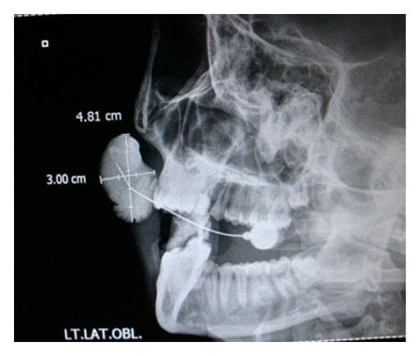 This diagnostic image is a lateral oblique sialography of the left parotid gland. The radiograph displays a radiopaque contrast medium introduced via a cannula to visualize Stensen's duct. A significant pathological finding is noted in the mid-cheek region, where the contrast medium pools into a large, well-defined, ovoid cystic lesion measuring approximately 4.81 cm x 3.00 cm. This accumulation represents focal ductal dilation or a sialocele. The contrast flows through the distal portion of the parotid duct but demonstrates no communication with the proximal glandular parenchyma, suggesting a complete obstruction or discontinuity. The anatomical landmarks of the mandible, maxilla, and dentition are visible in a lateral oblique projection, providing spatial context for the subcutaneous mass. This imaging is clinically significant for evaluating parotid duct abnormalities, such as strictures, sialolithiasis, or rare infections like rhinosporidiosis that can lead to secondary ductal ectasia.