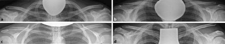 A composite of four bilateral anteroposterior (AP) stress radiographs of the shoulder girdle, illustrating different grades of acromioclavicular (AC) joint injuries according to the Rockwood classification system. These views are obtained under a 10-kg axial load to assess ligamentous stability. Image (a) represents a Rockwood Type I injury, showing normal anatomical alignment of the clavicle, acromion, and coracoid process. Image (b) corresponds to a Rockwood Type II injury, demonstrating mild superior displacement of the distal clavicle and slight widening of the AC joint space. Image (c) shows a Rockwood Type III injury, characterized by moderate superior displacement of the clavicle with increased coracoclavicular (CC) distance, indicating disruption of both AC and CC ligaments. Image (d) depicts a Rockwood Type V injury, featuring severe superior elevation of the distal clavicle relative to the acromion, resulting in a significantly increased CC distance and total loss of joint congruity. This series serves as an educational diagnostic tool for orthopedic evaluation and surgical decision-making in AC joint instability.