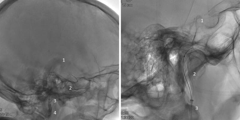 Two lateral fluoroscopic/angiographic views of the skull demonstrating an endovascular mechanical thrombectomy procedure in the cerebral vasculature. The images illustrate the triaxial spatial arrangement of interventional devices. A Solitaire stent retriever (1) is deployed distally within a cerebral artery, likely the internal carotid or middle cerebral artery, to engage a thrombus. Proximally, the Advanced Neurovascular Access (ANA) device is positioned, featuring an expanded, radiopaque braided funnel (2) that apposes the vessel walls to provide local flow restriction and enhanced aspiration. The ANA delivery catheter (3) is seen coaxially aligned with the funnel system. A larger guide catheter (4) is visible in the more proximal vasculature, providing the primary access route. The clinical significance of this setup is to show the combined use of a stent retriever with a specialized aspiration funnel to optimize clot retrieval and minimize distal embolization during acute ischemic stroke intervention. This material is suitable for intermediate to advanced neurointerventional training.