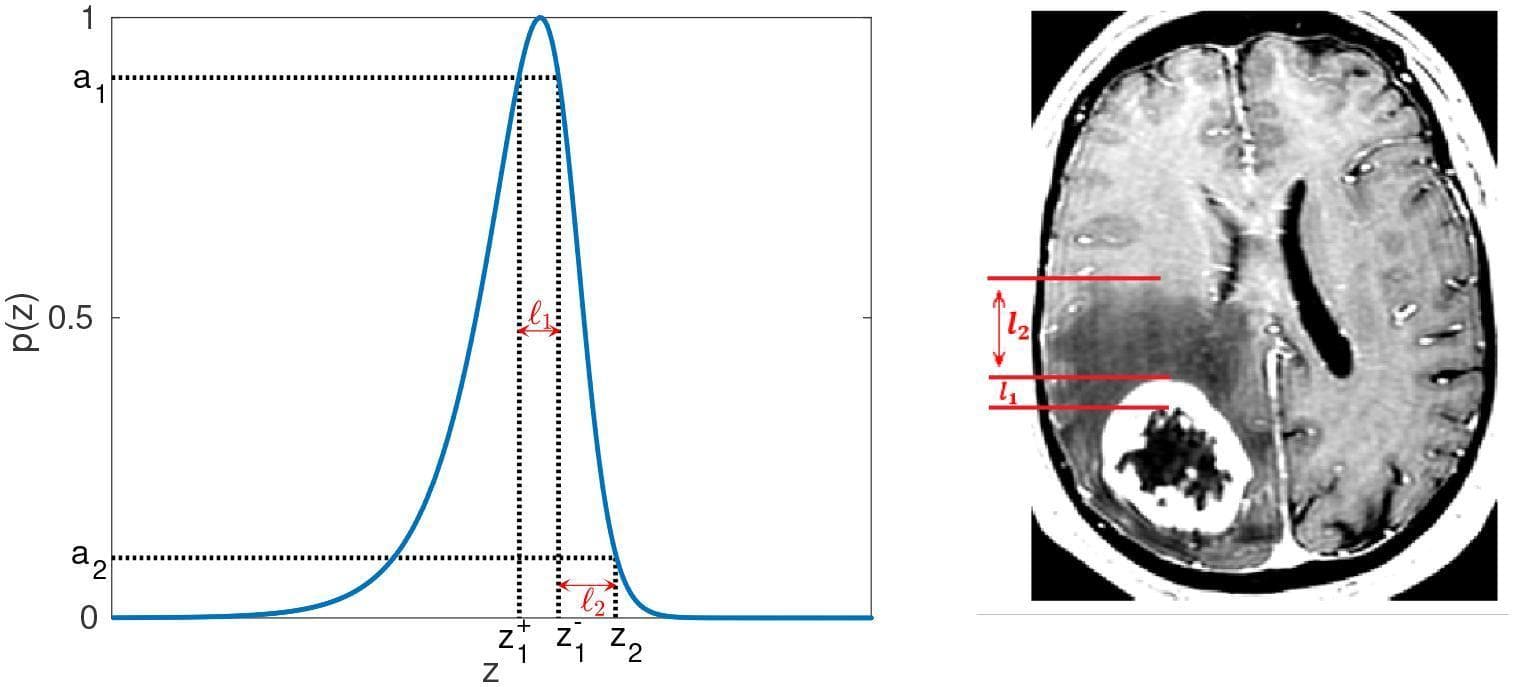 This dual-pane figure illustrates the mathematical modeling of tumor growth parameters matched with clinical neuroimaging. On the right, an axial T1-weighted contrast-enhanced MRI of the brain demonstrates a large, complex neoplasm. The tumor features a central, dark, non-enhancing necrotic core surrounded by a bright, contrast-enhancing rim. Anterior to the mass is a diffuse, hypointense region representing tumor-associated vasogenic edema. Red lines and arrows designate the width of the enhancing rim (l1) and the extent of the edematous region (l2). On the left, a corresponding Pathophysiology Diagram shows a normalized wave profile, p(z), representing the mathematical model of tumor cell density. The blue curve depicts a sigmoidal traveling wave where parameters a1 and a2 represent threshold densities. The intervals l1 (rim width) and l2 (edema width) are mapped onto the z-coordinate axis between specific points z1-, z1+, and z2. This comparison highlights how clinical imaging data for proliferating and edematous zones are used for model parameter estimation in oncology research.