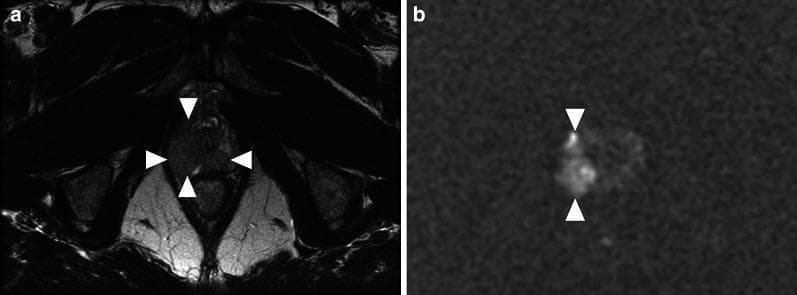 This diagnostic imaging set consists of two axial MRI slices of the prostate apex in a 62-year-old male. Image (a) is an axial T2-weighted (T2W) image showing a large, well-defined, hypointense lesion (arrowheads) located in the right lateral and posterior peripheral zone. The lesion replaces a significant portion of the normal high T2 signal of the peripheral zone tissue. Image (b) is an axial diffusion-weighted image (DWI, b = 2000 s/mm²) at the same level, which demonstrates pronounced high signal intensity (diffusion restriction) corresponding to the lesion seen in the T2W image. While these findings—T2 hypointensity combined with restricted diffusion—are highly characteristic of prostatic adenocarcinoma, the provided clinical context indicates this represents granulomatous (tuberculous) prostatitis following intravesical BCG therapy for bladder cancer. This comparison illustrates a significant pitfall in multiparametric MRI (mpMRI) interpretation, where inflammatory granulomatous processes can closely mimic the imaging phenotype of high-grade prostate cancer.