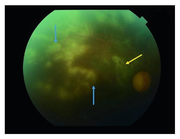 This clinical photograph is a fundus image of the right eye, demonstrating hallmark features of severe posterior uveitis, specifically cytomegalovirus (CMV) retinitis in an immunocompromised patient. The image shows significant optic disc pallor and generalized vitreous haze, which obscures the fine detail of the retinal vasculature. Multiple large, confluent, white-to-off-yellow granular exudates (noted by blue arrows) are visible, concentrated around the macular area and extending into the peripheral retina, consistent with active necrotizing retinitis. A distinct area of pigmentation and thinning, indicated by a yellow arrow, represents an old, atrophic choroidal scar. The presence of these chorioretinal lesions alongside the optic nerve pallor illustrates the extensive retinal destruction and secondary optic neuropathy often seen in progressive viral infections of the retina. The educational focus is on identifying active infectious lesions versus chronic scarring and assessing the degree of vitritis and optic nerve involvement in inflammatory eye disease.
