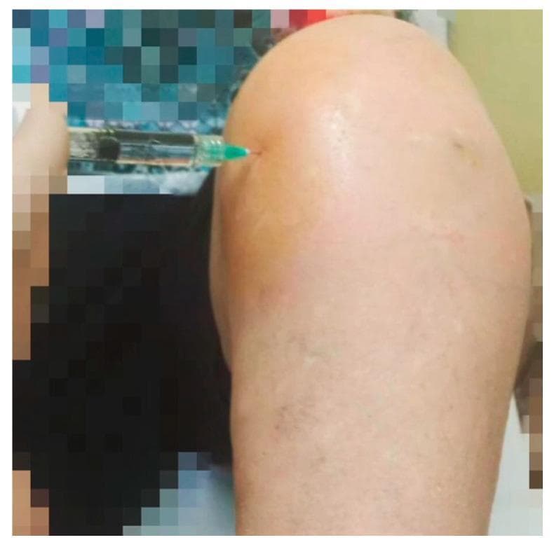 A clinical photograph demonstrating a Medial Infrapatellar (MIP) technique for intra-articular knee injection. The patient's left knee is positioned in approximately 45 degrees of flexion. A 21-gauge needle attached to a clear syringe is seen inserted into the medial aspect of the knee joint. The entry point is located approximately 1 cm inferior and 1 cm medial to the inferior medial margin of the patella. The needle is oriented at an oblique angle, directed toward the retro-patellar space. The surrounding skin shows yellow-brown discoloration consistent with povidone-iodine antiseptic preparation. This image illustrates a common orthopedic procedure for the administration of viscosupplementation, such as hyaluronic acid, or corticosteroids in the management of knee osteoarthritis. The visual focus is on the anatomical landmarks for safe needle placement to ensure intra-articular delivery.