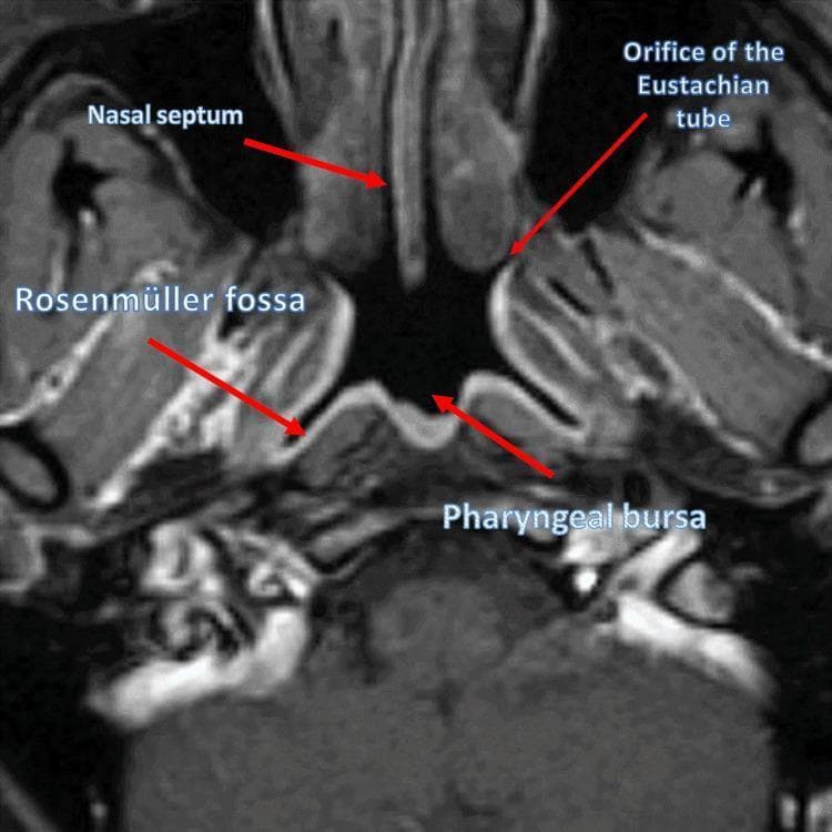 This diagnostic image is an axial (transverse) Magnetic Resonance Imaging (MRI) scan of the human nasopharynx in a healthy subject. The view provides a detailed anatomical study of the upper airway and its surrounding mucosal landmarks. Centrally, the posterior aspect of the nasal septum is visible, exhibiting a slight lateral deviation. The nasopharyngeal lumen is clearly defined, showing key lateral and posterior wall structures. The Rosenmüller fossa (lateral pharyngeal recess) is identified as a deep indentation on the lateral wall, appearing with a heterogeneous signal intensity and ill-defined borders. Anterior to this fossa is the orifice of the Eustachian tube, visualized as a small opening with a dark signal. On the midline of the posterior wall, the pharyngeal bursa is depicted as a small, smooth-contoured protrusion. This imaging modality is essential for evaluating obstructive sleep apnea (OSA), nasopharyngeal carcinoma, or lymphoid hypertrophy, as it allows for precise assessment of spatial relationships and mucosal symmetry within the rhinopharynx.