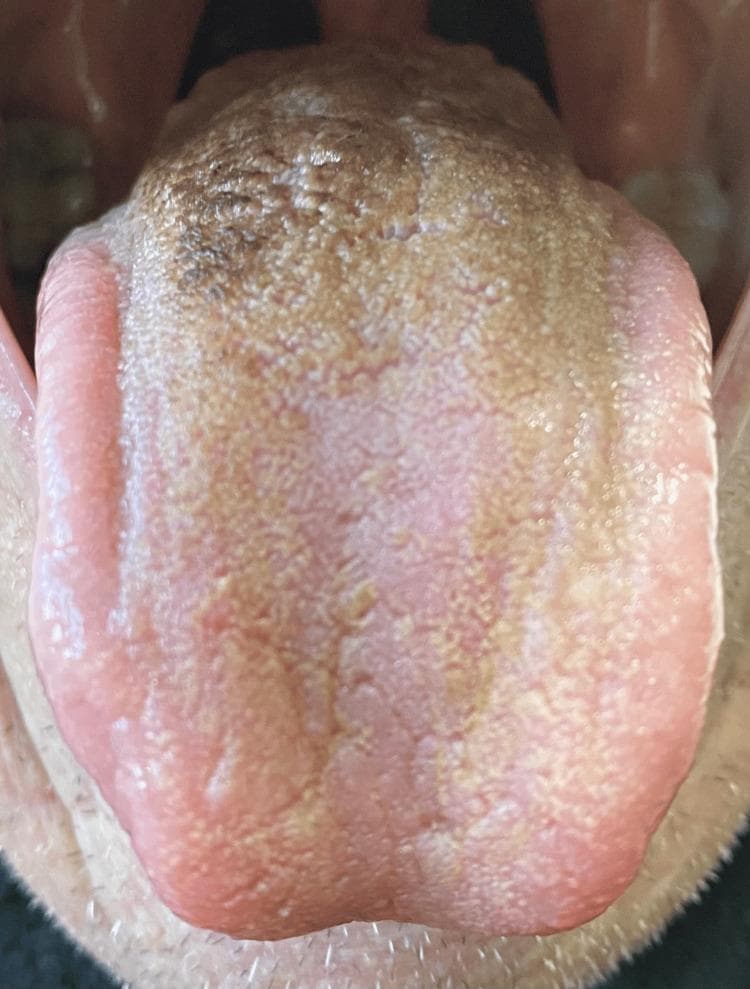 This clinical photograph displays a superior (dorsal) view of a human tongue exhibiting signs of Lingua Villosa Nigra, commonly known as black hairy tongue. The visual findings demonstrate significant hypertrophy and elongation of the filiform papillae across the posterior and central dorsum. These elongated papillae show a varying degree of discoloration, ranging from a dark brown-black hue in the most posterior region to a tan-brown or yellowish-brown coating toward the mid-tongue. The anterior tip and lateral borders of the tongue appear relatively spared, retaining a more natural pink color with visible but normal-sized papillae. The texture of the affected area appears thickened and 'hairy' or 'furry' due to the accumulation of keratin and chromogenic debris. This diagnostic image illustrates a typical adverse drug reaction or oral hygiene-related manifestation, specifically highlighting the characteristic distribution of papillary changes and extrinsic staining on the dorsal surface of the tongue.