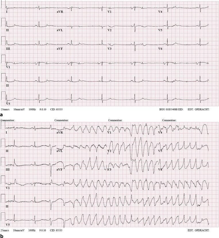 Two-part 12-lead electrocardiogram (ECG) comparison demonstrating drug-induced arrhythmia. (a) Initial ECG showing sinus bradycardia at approximately 40 bpm. Findings include narrow QRS complexes, prolonged QT interval, and T-wave abnormalities (inversions in inferior leads II, III, and aVF). This baseline demonstrates common findings in patients on QT-prolonging agents like sotalol. (b) ECG recorded during a syncopal event, displaying a transition from sinus rhythm into a polymorphic ventricular tachycardia (Torsades de Pointes). The tachycardia is characterized by wide QRS complexes (duration >120ms) with a shifting axis, rotating around the isoelectric line at a rapid rate of 150-200 bpm. The visual sequence illustrates the clinical progression from drug-induced QT prolongation to life-threatening ventricular arrhythmia. Educational focus is on identifying bradycardia, QT prolongation, and the morphology of polymorphic ventricular tachycardia in the context of syncope.