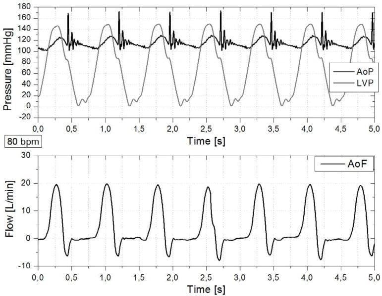 This physiological waveform graph displays cardiac simulator signals at a heart rate of 80 bpm, illustrating hemodynamic relationships across the cardiac cycle over a 5-second interval. The upper panel tracks Pressure (mmHg), comparing Left Ventricular Pressure (LVP) and Aortic Pressure (AoP). The LVP waveform shows cyclical rises to approximately 150 mmHg during systole, falling near 0 mmHg in diastole. The AoP oscillates between roughly 105 and 130 mmHg, with distinct high-frequency spikes (dicrotic notches/oscillations) occurring at the moment of mechanical aortic valve closure. The lower panel displays Aortic Root Flow (AoF) in L/min, showing pulsatile flow synchronized with pressure changes. Flow peaks at approximately 20 L/min during the rapid ejection phase and exhibits a brief negative deflection (backflow) to roughly -8 L/min, indicating closure of the aortic valve. These waveforms serve as a diagnostic algorithm illustration for understanding the relationship between chamber pressure, arterial pressure, and forward stroke volume in cardiovascular physiology.