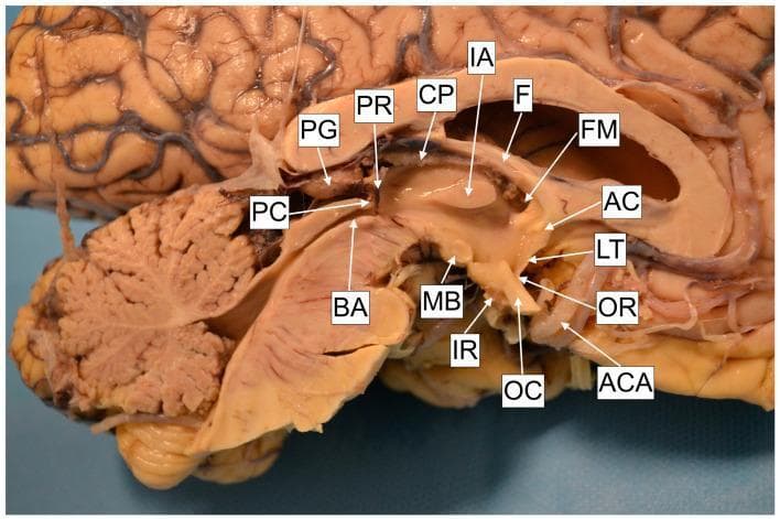 A high-resolution anatomical dissection of a human cadaver brain specimen in a sagittal section, focused on the micro-anatomy of the third ventricle and surrounding diencephalic structures. The image shows the internal walls and landmarks essential for neurosurgical procedures like endoscopic third ventriculostomy (ETV). Key labeled structures include the anterior commissure (AC) and lamina terminalis (LT) forming the anterior wall, and the optic recess (OR) and infundibular recess (IR) along the floor. Posteriorly, the mamillary body (MB), brain aqueduct (BA), posterior commissure (PC), and pineal gland (PG) with its recess (PR) are visible. Superiorly, the foramen of Monro (FM) connects to the lateral ventricle, bordered by the fornix (F) and choroid plexus (CP). The interthalamic adhesion (IA) is noted centrally. Vascular proximity is demonstrated by the anterior cerebral artery (ACA) near the optic chiasm (OC). The cerebellum and brainstem are also partially visible, providing anatomical context for the midline ventricular system.