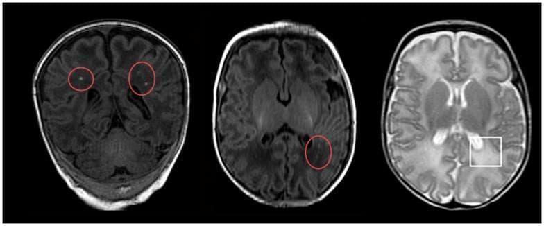 Diagnostic axial MRI images of a neonatal brain demonstrating pathological changes associated with hypoxic-ischemic encephalopathy (HIE) and white matter injury. The image panel contains two T1-weighted sequences and one T2-weighted sequence. On the T1-weighted images (left and center), red circles highlight multiple small, punctate hyperintensities located within the periventricular and subcortical white matter of the frontal and temporal lobes, characteristic of focal white matter lesions. On the T2-weighted image (right), a white square demarcates a region of diffuse excessive high signal intensity (DEHSI) in the posterior periventricular white matter, primarily involving the occipital region. This T2-hyperintensity is indicative of increased water content, such as vasogenic edema or dysmyelination. These imaging findings represent common neuroradiological markers for neonatal seizures and subsequent neurodevelopmental risks following hypoxic-ischemic events.