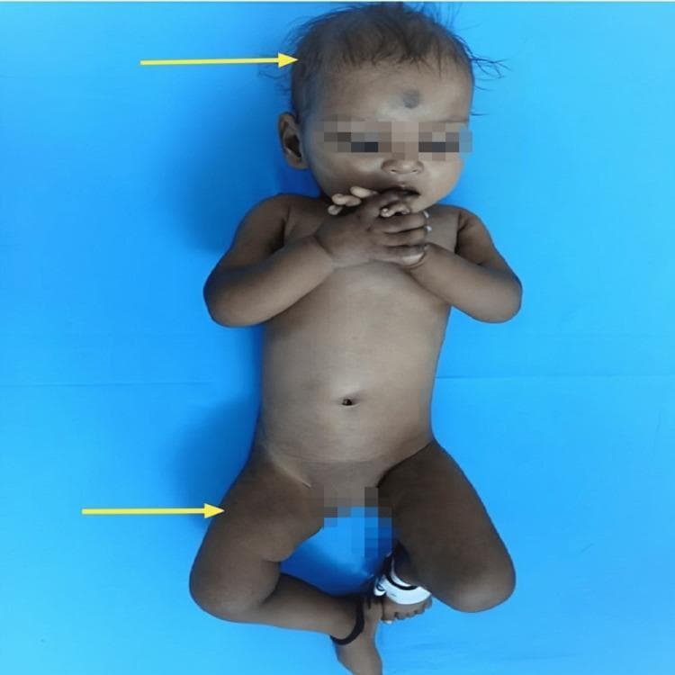 Clinical photograph of a pediatric patient exhibiting characteristic dermatological and hair changes associated with nutritional deficiencies, specifically Vitamin B12 deficiency. The image shows an infant with sparse, coarse, and hypopigmented scalp hair (indicated by the upper arrow). Significant cutaneous findings include hyperpigmentation of the knuckles on both hands and a diffuse reticular (net-like) pigmentation pattern across the lower extremities (indicated by the lower arrow). The patient also appears mildly edematous or 'plump' despite malnutrition markers. These clinical signs—knuckle hyperpigmentation and reticular skin changes—are classic cutaneous markers of megaloblastic anemia in infants, often secondary to maternal vegetarian diets or malabsorption. The visual serves as an educational tool for identifying systemic metabolic disorders through external physical examination findings in a pediatric clinical context.