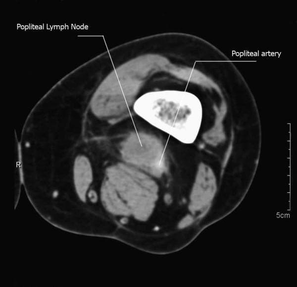 Axial MRI (T1-weighted image) of the popliteal region showing a metastatic mass originating from squamous cell carcinoma. The visual identifies a primary soft-tissue mass, labeled as a popliteal lymph node, measuring approximately 3 cm in size within the popliteal fossa. The mass is hyperintense relative to adjacent muscle and demonstrates a close anatomical relationship with the vascular bundle, specifically encasing the popliteal artery, which is labeled for reference. The image illustrates the complex anatomy of the posterior knee, including the femur and surrounding musculature. This diagnostic image is intended for medical education regarding oncological staging, regional lymphatic spread, and the surgical considerations of popliteal lymphadenectomy when tumors approximate major neurovascular structures.