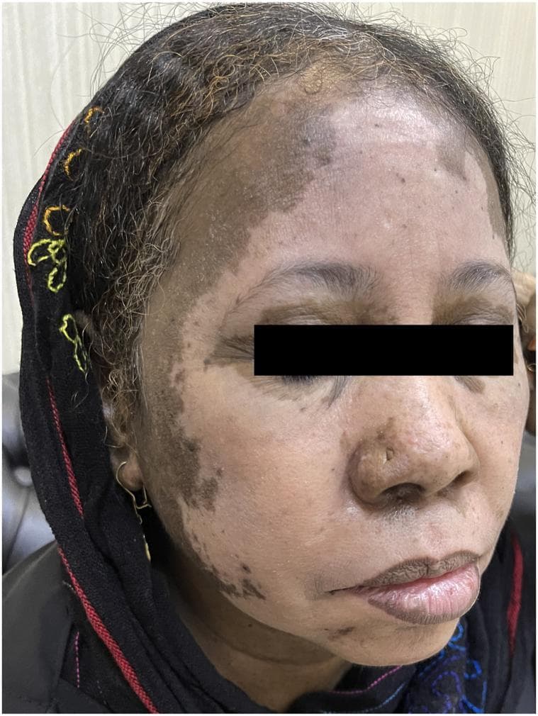 This clinical photograph shows a close-up frontal view of a patient's face, demonstrating extensive, well-demarcated patches of depigmentation. The condition is identified as drug-induced vitiligo secondary to carbamazepine. Large, milk-white depigmented macules and patches are most prominent on the forehead, right cheek, and extending along the preauricular region into the hairline. The distribution is asymmetrical, with notable involvement of the right temple and upper cheek, while the left side shows milder, mottled hypopigmentation. Perioral involvement is also visible, with depigmentation appearing at the vermilion border of the lower lip. The surrounding skin exhibits normal pigmentation, creating a sharp contrast with the affected areas. There is no evidence of secondary changes such as scaling, crusting, or ulceration. This image serves as a clinical example of chemically induced leucoderma, highlighting the importance of medication history in the evaluation of rapid-onset pigmentary disorders.