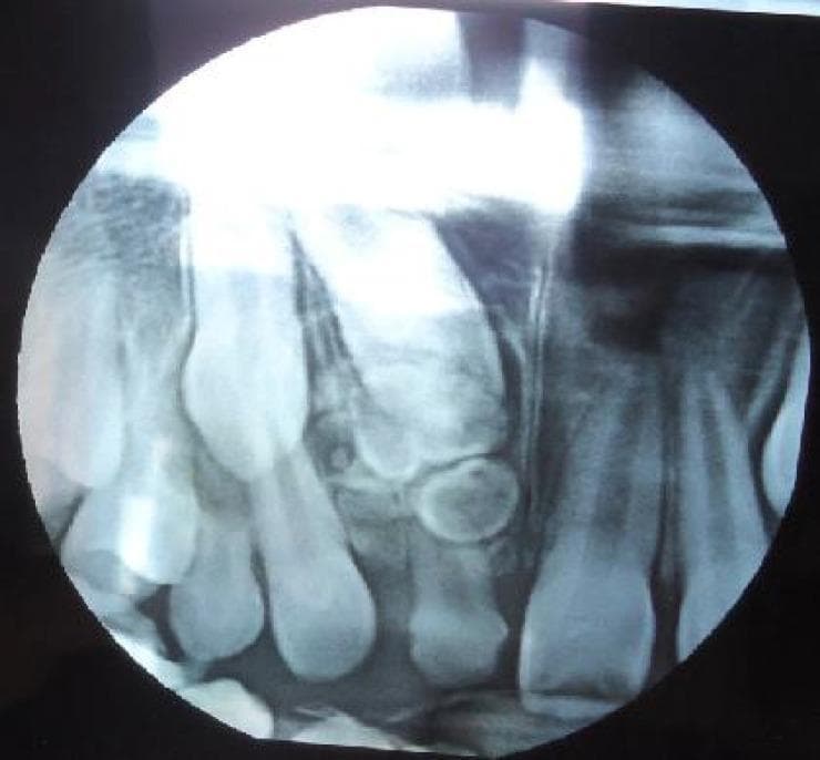 This intraoral periapical radiograph of the anterior maxilla demonstrates a complex odontoma associated with an impacted permanent tooth. The diagnostic image reveals a cluster of multiple, small, irregularly shaped radiopaque masses of varying densities located superior to the crown of an unerupted permanent maxillary incisor. These odontogenic structures act as a physical obstruction, resulting in the failure of eruption of the permanent tooth and the prolonged retention of its deciduous predecessor. Additionally, the radiograph shows mesial drifting of the adjacent lateral incisor, narrowing the eruption space. The visual evidence of calcified dental tissues in a disorganized arrangement is characteristic of a compound or complex odontoma, a common benign odontogenic hamartoma. This image is clinically significant for dental students and maxillofacial radiologists in identifying causes of delayed tooth eruption and interpreting odontogenic tumors in pediatric patients.
