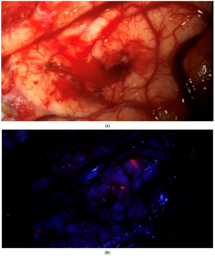 Comparison of intraoperative neurosurgical visualization using white light and fluorescence-guided imaging. Image (a) depicts a macroscopic view of the brain parenchyma under standard white light after tumor resection. The surgical field shows cortical tissue with visible branching vasculature, areas of pinkish-white healthy-appearing tissue, and minor localized hemorrhage. Under this lighting, the field appears 'clean' with no obvious residual tumor. Image (b) shows the identical anatomical field under blue light excitation. The background tissue appears dark violet/blue, while specific focal points of bright red fluorescence are clearly visible. This contrast-enhanced view identifies residual pathological tissue, likely using 5-aminolevulinic acid (5-ALA) induced protoporphyrin IX fluorescence, which is not discernible to the naked eye under conventional illumination. This comparison illustrates the clinical utility of fluorescence-guided surgery (FGS) in neuro-oncology for identifying infiltrative tumor margins and ensuring more complete resection of malignant gliomas or meningiomas.