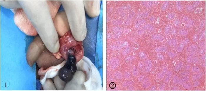 This dual-panel image demonstrates the surgical and pathological findings of testicular torsion associated with a bell clapper deformity. Panel 1 is an intraoperative clinical photograph of an inguinal/scrotal exploration. It shows a dark, cyanotic, and necrotic-appearing testis and epididymis held by gloved fingers. The tunica vaginalis is seen completely encircling the testis and distal spermatic cord, which characterizes the bell clapper deformity and allows the testis to rotate freely within the sac, leading to intravaginal torsion. Panel 2 is a histopathological micrograph (H&E stain) of the testicular tissue. The image reveals extensive coagulative necrosis of the seminiferous tubules and significant interstitial hemorrhage, indicated by the diffuse pink staining and loss of cellular and nuclear detail. This content illustrates a critical urologic emergency and is intended for medical professionals and students to recognize the gross and microscopic manifestations of non-viable testicular tissue following severe torsion.