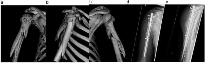 This composite medical image displays pre-operative and post-operative imaging of a humeral shaft fracture, classified as AO 12-B2. Panels a, b, and c show pre-operative 3D computed tomography (CT) reconstructions from three different rotational perspectives. These images reveal a displaced, wedge-type (comminuted) fracture located in the proximal to mid-diaphyseal region of the humerus. Significant angulation and separation of cortical fragments are visible. Panels d and e are post-operative X-ray radiographs in anteroposterior (AP) and lateral views. They demonstrate surgical stabilization using antegrade intramedullary nail osteosynthesis. The nail is centrally positioned within the medullary canal, spanning the fracture site to restore axial alignment. Proximal and distal stability is achieved via multiple locking screws. Additionally, radiopaque cerclage wiring is visible, providing supplementary fixation of the wedge fragment to the main humeral shaft. The combination of techniques illustrates a modern orthopedic approach to complex long-bone fractures, focusing on both intramedullary and extramedullary stabilization for optimal bony consolidation.