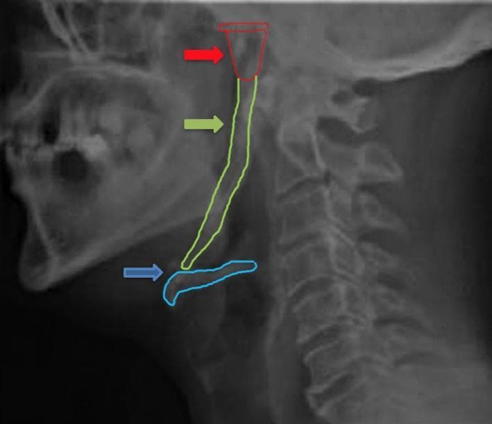A lateral neck X-ray (radiography) demonstrating extensive ossification of the stylohyoid complex. The image features color-coded outlines and arrows highlighting key anatomical structures: a red arrow and outline identify the styloid process of the temporal bone; a green arrow and outline delineate the continuous, elongated radiopaque ossification of the stylohyoid ligament; and a blue arrow and outline mark the hyoid bone. The ossification forms a near-continuous bony chain extending from the skull base to the lesser cornua of the hyoid bone, showing non-uniform thickness and density along its length. This radiographic finding is characteristic of Eagle syndrome or asymptomatic stylohyoid ligament mineralization. Other visible landmarks include the cervical vertebrae (C1-C7) and the mandible. This diagnostic image is intended for educational use in oral and maxillofacial radiology or otolaryngology to illustrate pathological mineralization of soft tissues in the neck.