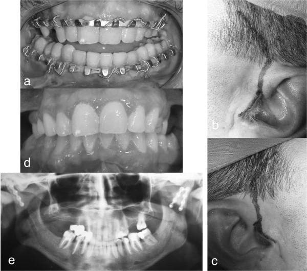 A multi-panel clinical photograph and diagnostic set documenting the surgical management of a mandibular sub-condylar bilateral fracture. Panel (a) shows an intraoral view of an anterior open-bite with posterior precontact, stabilized by metal arch bars (Erich-style splints) secured with circumdental wire ligatures for maxillomandibular fixation (MMF). Panels (b) and (c) display bilateral preauricular surgical approaches, featuring curved skin incisions anterior to the auricle and extending into the temporal hairline for access to the temporomandibular joint (TMJ) and condylar region. Panel (d) illustrates the postoperative clinical result with restored dental occlusion and a corrected occlusal plane. Panel (e) is a postoperative orthopantomogram (OPG) radiograph confirming bilateral open reduction and internal fixation (ORIF) of the sub-condylar fractures with osteosynthesis plates and screws. This image set serves as an educational resource for maxillofacial trauma, detailing the progression from preoperative malocclusion to surgical access and successful radiographic and clinical reduction.