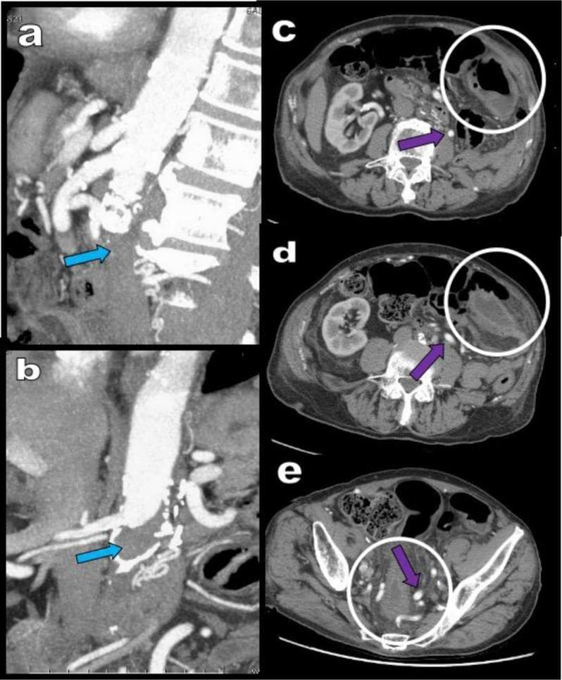 This composite diagnostic image features Multidetector Computed Tomography Angiography (MDCTA) views illustrating Leriche syndrome (aortoiliac occlusive disease) and its complications. Figures (a) sagittal and (b) coronal Multiplanar Reconstruction (MPR) demonstrate complete thrombotic occlusion of the abdominal aorta starting immediately distal to the origin of the renal arteries, indicated by blue arrows. Serial axial CT views (c, d, e) highlight secondary clinical manifestations. White circles denote significant thickening and hypodensity of the descending colonic wall, characteristic of ischemic colitis. Purple arrows point to massive, hypertrophied, and tortuous arterial collateralization along the expected course of the inferior mesenteric artery (IMA), representing compensatory vascular remodeling (e.g., meandering mesenteric artery) to bypass the aortic obstruction. The presence of these large collaterals underscores the chronic nature of the vascular occlusion. This educational material is suitable for vascular surgery and radiology instruction, focusing on aortic pathology and visceral ischemic consequences.