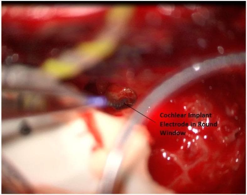 This clinical photograph provides an intraoperative view of a cochlear implant surgery, specifically demonstrating the placement of the electrode array into the round window. The image shows a focused surgical field within the mastoid cavity, characterized by erythematous, moist soft tissue and exposed bone. The primary feature is a dark, segmented cochlear implant electrode array being inserted through the round window niche. A distinctive blue light from a surgical instrument or laser is visible near the insertion point, aiding in precise localization. Surrounding the insertion site, metallic surgical instruments are visible, including a suction tip or dissector, alongside a translucent drainage or suction tube. The surgical field contains evidence of minor bleeding, consistent with active otological surgery. This visual illustrates a critical step in cochlear implantation—accessing the scala tympani via the round window to restore auditory function.