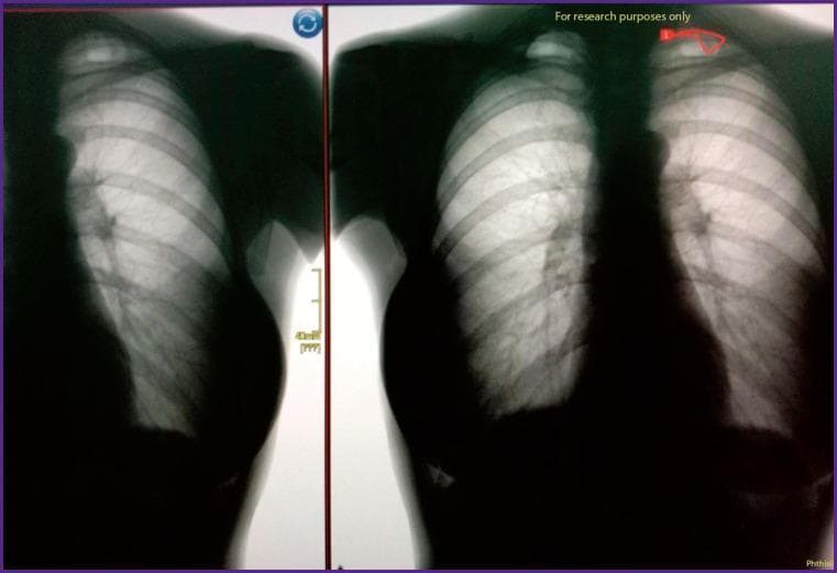 This diagnostic image displays a side-by-side comparison of a posterior-anterior (PA) chest X-ray, illustrating the detection of a congenital cervical rib. The left panel shows the original radiograph, while the right panel highlights the pathology using red artificial intelligence (AI) annotation. Anatomical landmarks include the thoracic spine, rib cage, bilateral clavicles, and radiolucent lung fields. In the right-side image, a small, accessory bony structure (cervical rib) is visible originating from the transverse process of the seventh cervical vertebra (C7), superior to the first thoracic rib. This finding is clinically significant as it may be associated with thoracic outlet syndrome due to potential compression of the brachial plexus or subclavian vessels. The visual demonstrates the application of deep learning algorithms in identifying musculoskeletal anomalies and incidental pulmonary findings during routine fluorographic or radiographic screenings.