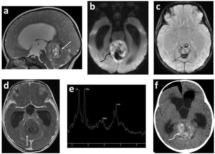 Multi-modal neuroimaging of a five-month-old infant demonstrating a large posterior fossa mass pathologically confirmed as an atypical teratoid rhabdoid tumor (ATRT). (a) Sagittal T2-weighted MRI shows a heterogeneous, cystic-solid mass in the superior/anterior cerebellar vermis effacing the fourth ventricle, with visible fluid-fluid levels within cystic components. (b) Axial Diffusion-Weighted Imaging (DWI) demonstrates areas of restricted diffusion, suggesting high cellularity. (c) Axial SWAN sequence reveals internal hemorrhage (hypointense signals). (d) Axial T1 inversion recovery post-contrast image shows a lack of significant enhancement. (e) Proton MR spectroscopy (H-MRS) displays a high Choline (Cho) peak, markedly elevated Myoinositol (mI), decreased N-acetylaspartate (NAA), and a present Lactate (Lac) doublet, characteristic of aggressive embryonal tumors. (f) Axial non-contrast CT shows high-density areas within the mass consistent with acute hemorrhage, and evidence of post-ventricular shunt placement. The imaging collectively illustrates a malignant pediatric CNS embryonal tumor causing mass effect and obstructive hydrocephalus.