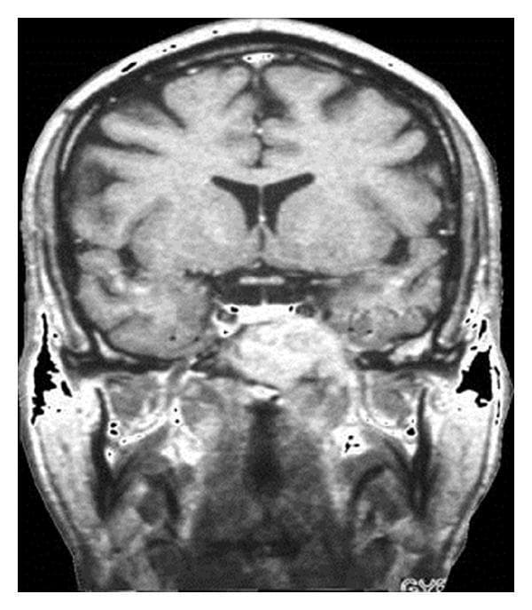 This diagnostic image is a coronal T1-weighted cranial MRI scan showing the brain and skull base. The image demonstrates a large, hyperintense, well-demarcated lesion localized in the left cranial base, measuring approximately 4 cm. The mass involves the region of the sphenoid sinus and extending toward the foramina lacerum and ovale, causing visible anatomical distortion and bone destruction compared to the contralateral side. Superiorly, the cerebral hemispheres, lateral ventricles, and interhemispheric fissure appear intact but the lesion lies in close proximity to the temporal lobe and pituitary region. The clinical significance of this finding represents Langerhans cell histiocytosis (eosinophilic granuloma) of the cranial base, which in this case presented with fifth cranial nerve (trigeminal nerve) hypesthesia. The image serves as a baseline for radiotherapy planning and illustrates the typical aggressive local presentation of histiocytic lesions in adult patients within the neurosurgical and oncological specialty.