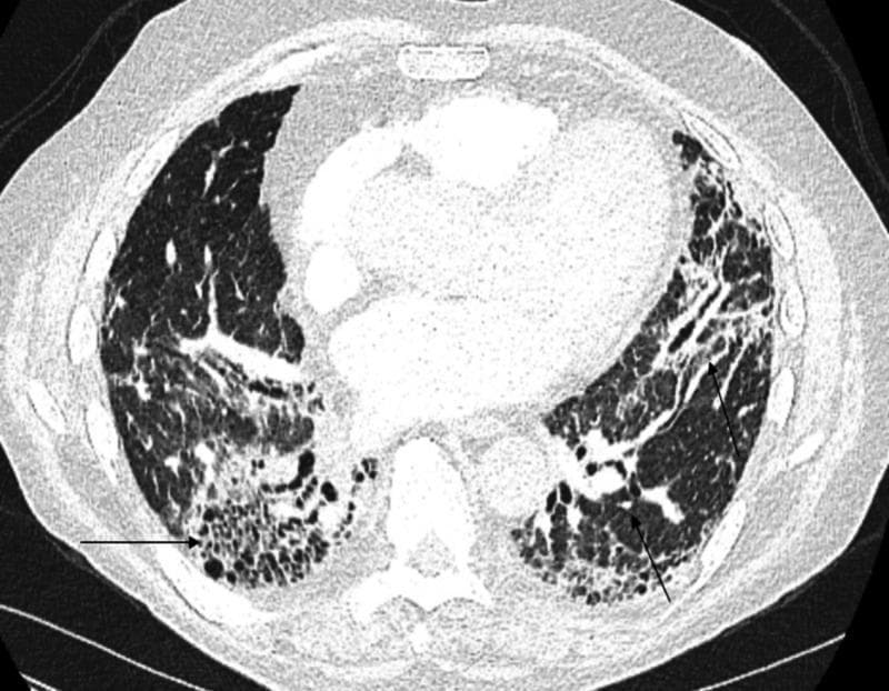 This diagnostic image is an axial chest CT scan showing a cross-section of the thorax. The image demonstrates a pattern of chronic interstitial lung disease with features consistent with Usual Interstitial Pneumonia (UIP). Prominent findings include bilateral, subpleural honeycombing, characterized by clustered, thick-walled cystic airspaces primarily located in the lower lobes. Also visible are subpleural reticular opacities and architectural distortion. Traction bronchiectasis is evident, marked by the abnormal dilation of the airways (indicated by arrows) within areas of surrounding fibrosis. These features signify irreversible lung parenchymal scarring and destruction. The distribution is predominantly peripheral and basilar, typical of advanced pulmonary fibrosis, which in this clinical context is associated with drug-induced lung injury. This scan is an essential educational example for identifying the hallmark radiologic features of interstitial fibrosis and traction bronchiectasis in a clinical setting.