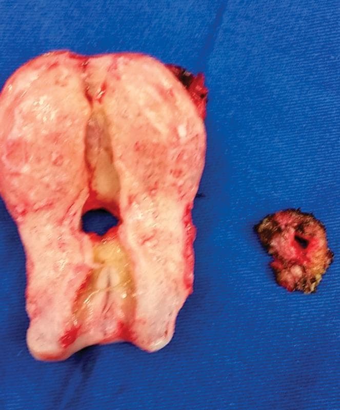 This clinical photograph displays a macroscopic view of surgical specimens from a hysterectomy and fistulectomy, illustrating a vesicouterine fistula (Youssef syndrome). The larger specimen is a mid-sagittal section of the uterus, showing a pale, fibromuscular myometrium. A distinct, rounded fistulous orifice is located in the lower uterine segment, just superior to the cervical canal. The surrounding tissue near the orifice exhibits yellowish-white discoloration, characteristic of chronic inflammation or scarring. To the right, a smaller, irregular excised segment of the bladder wall is shown, featuring a corresponding patent orifice with dark, hemorrhagic edges. This pathological specimen demonstrates the direct communication between the bladder and the uterus, which clinically manifests as cyclic menouria (presence of menstrual blood in urine) and the absence of normal vaginal menstruation. The image is an important educational resource for understanding the gross anatomy of iatrogenic urogenital fistulas following cesarean sections.