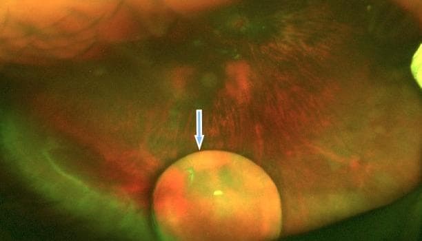 This diagnostic image is a wide-field fundus photograph of the right eye demonstrating a complete posterior lens dislocation (ectopia lentis). The primary focal point, indicated by a light blue arrow, is the crystalline lens, which has migrated into the posterior segment and is resting on the inferior retinal surface within the vitreous cavity. The lens appears as a well-defined, translucent, globular structure with an orange-brown tint and greenish surface reflections. The underlying retinal background exhibits a reddish-orange hue with visible retinal vasculature and mottled pigmentation, suggestive of myopic changes. The image highlights significant ocular trauma or systemic connective tissue pathology, illustrating the total separation of the lens from the ciliary zonules. This clinical photograph is a key educational resource for ophthalmology, focusing on vitreoretinal complications and the management of dislocated lenses.