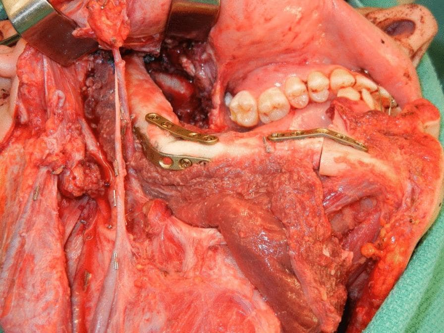 This clinical photograph captures an intraoperative view of a complex oral and maxillofacial reconstruction using a fibula free flap (FFF). The surgical site reveals a large mandibular defect being restored with a vascularized fibula bone graft. Key anatomical landmarks include the maxillary teeth and hard palate providing superior orientation. The transplanted fibula is contoured at its distal end to function as a neo-condyle, positioned within the native glenoid fossa to reconstruct the temporomandibular joint (TMJ). Rigorous internal fixation is achieved via metallic osteosynthesis plates and screws, securing the fibula segments to the remnant mandible. The image also demonstrates the soft tissue component of the flap and the associated vascular pedicle, essential for microvascular anastomosis. This procedure illustrates a standard approach for functional and aesthetic restoration following radical mandibular resection, highlighting the integration of the neo-condyle with the remnant joint capsule to maintain jaw mobility.