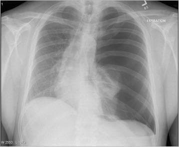 This diagnostic image is a posterior-anterior (PA) chest radiograph demonstrating a large left-sided tension pneumothorax. The left hemithorax shows marked hyperlucency with a complete absence of pulmonary vascular markings, characteristic of air in the pleural space. The left lung is fully collapsed (total atelectasis), visible as a visceral pleural edge retracted toward the hilum. There is significant mass effect evidenced by a rightward mediastinal shift, displacing the heart and trachea toward the contralateral side. Additional findings include widening of the left intercostal spaces and flattening of the left hemidiaphragm, indicating increased intrapleural pressure. This represents a medical emergency requiring immediate needle decompression or chest tube thoracostomy. The image serves as a classic educational example of tension pneumothorax for medical students and clinicians, illustrating the radiological hallmarks of pleural air accumulation and subsequent pressure-induced shift of mediastinal structures.