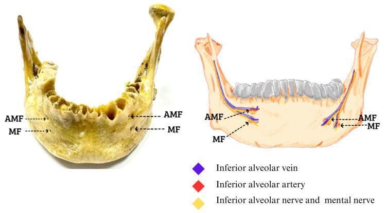 This composite educational image features a clinical photograph of a dry human mandible alongside a corresponding anatomical diagram, illustrating the bilateral presence of an accessory mental foramen (AMF). The photograph shows the anterior-lateral view of the mandible with labels pointing to the primary mental foramen (MF) and the smaller AMF located superior and slightly posterior to it on both the right and left sides. The accompanying diagram details the neurovascular bundle associated with these structures. It depicts the inferior alveolar vein (purple), inferior alveolar artery (red), and the inferior alveolar/mental nerve (yellow) traveling through the mandibular canal. The illustration highlights the branching of these neurovascular structures as they exit through both the MF and the AMF. This visual is designed for anatomy and oral surgery education, emphasizing anatomical variations of the mandibular neurovascular exit points which are critical for local anesthesia and surgical procedures in the chin and lower lip region.