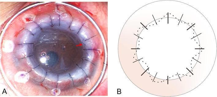 This dual-panel image features an intraoperative clinical photograph (A) and a matching schematic diagram (B) detailing a combined suturing technique for penetrating keratoplasty (PK). Panel A shows a large-diameter corneal graft in situ. The recipient cornea appears thickened and opaque with significant stromal edema. A combination of radial interrupted sutures and a continuous intrastromal running suture (highlighted by a red arrow) is visible across the graft-host junction. Small fluid-filled bullae are present on the corneal surface. Panel B provides a schematic representation of the surgical technique: coarse solid lines indicate the initial eight radial interrupted sutures, a dotted line represents the continuous intrastromal suture passing through deep stromal layers, and fine solid lines depict eight additional interrupted sutures used for reinforcement. The diagram illustrates how the needle entry and exit points for the continuous suture coincide to ensure deep tissue placement, bypassing the epithelial layer to maximize graft stability in complex cases like advanced keratoconus with hydrops.