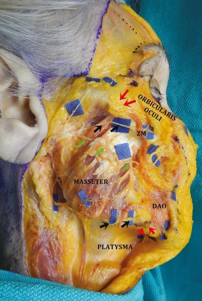 This clinical photograph displays a cadaveric dissection of the right hemiface, highlighting critical surgical anatomy for rhytidectomy (facelift). The skin and subcutaneous tissue are reflected medially, and the superficial muscular aponeurotic system (SMAS) and parotid gland have been removed to expose the underlying facial nerve branches and musculature. Key landmarks identified include the masseter, orbicularis oculi, zygomaticus major (ZM), platysma, and depressor anguli oris (DAO). Black arrows indicate the superior set (zygomatic branches) passing inferior to the zygomatic ligament (red arrow) into the 'sub-SMAS danger zone' deep to the ZM. Green arrows identify the buccal branches of the facial nerve. The inferior set of black arrows shows the marginal mandibular branch traveling past the mandibular osseocutaneous ligament (red arrow) to innervate the DAO on its deep surface. This visual serves as an educational guide for identifying facial nerve danger zones during deep-plane surgical dissection to avoid iatrogenic nerve injury.
