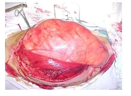Intraoperative clinical photograph showing a large, encapsulated soft tissue tumor within the right thigh of a 44-year-old male. The surgical field displays a massive, well-circumscribed, lobulated mass with a predominantly reddish-pink and yellowish-pale surface, characteristic of a liposarcoma or a giant lipoma. The tumor, measuring approximately 27 cm by 25 cm, is seen displacing and stretching the adjacent thigh musculature, specifically the adductor and quadriceps muscle groups. The overlying skin and subcutaneous tissues are retracted, revealing the deep muscular planes and the substantial size of the neoplasm relative to the surrounding anatomy. Surgical instruments, including clamps, are visible at the periphery of the incision site. This image demonstrates the clinical presentation of a giant soft tissue tumor and the necessary surgical exposure for marginal excision.