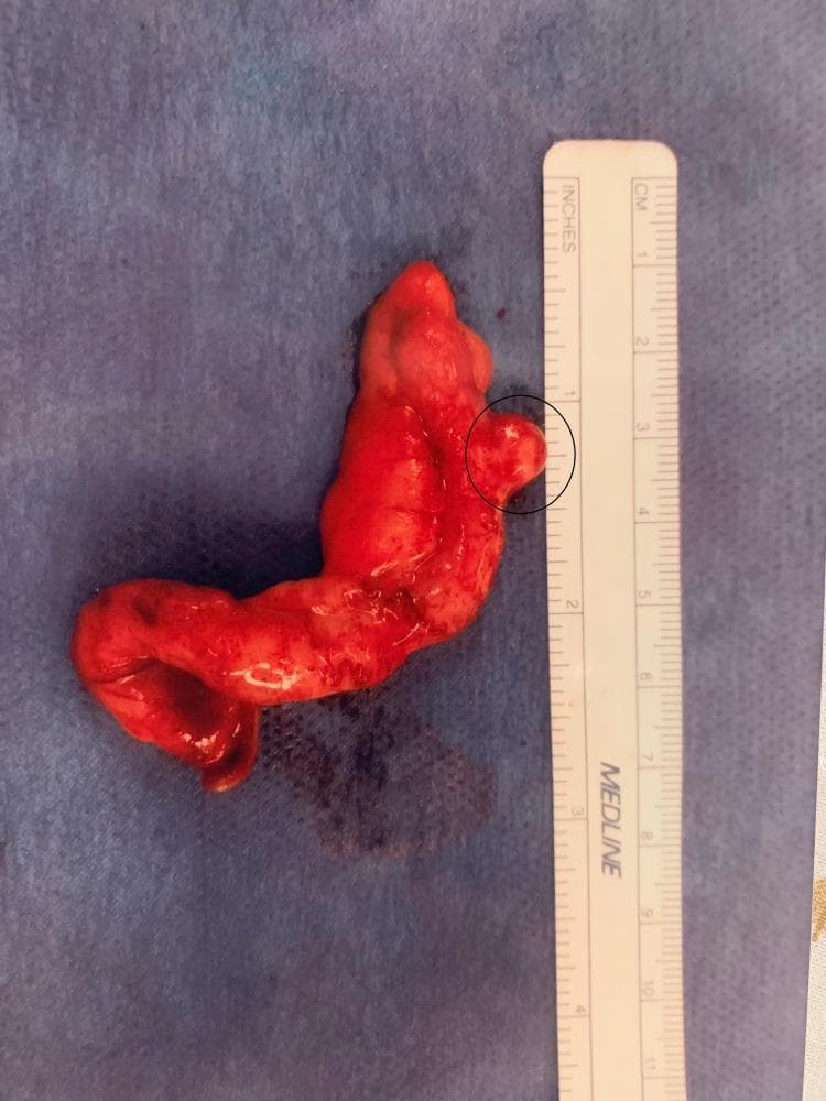 Content Type: Clinical Photograph (Gross Pathology Specimen). Anatomy: Appendix. This image displays a surgically resected vermiform appendix positioned against a sterile blue drape and a metric ruler for scale. The specimen measures approximately 7.5 cm in length and 1.5 cm in width. The serosal surface is diffusely erythematous and hyperemic, with irregular contours consistent with acute inflammation and focal serositis. A black circle highlights a prominent, rounded outpouching measuring roughly 0.5 cm in diameter located along the distal third of the organ. This visual finding is characteristic of an appendiceal diverticulum. The overall presentation demonstrates appendiceal diverticulosis in the setting of acute appendicitis. Clinical Significance: Appendiceal diverticulitis is a rare variant of appendicitis that carries a higher risk of perforation and may be associated with underlying neoplasms, though this specimen primarily illustrates the morphological findings of diverticular inflammation.
