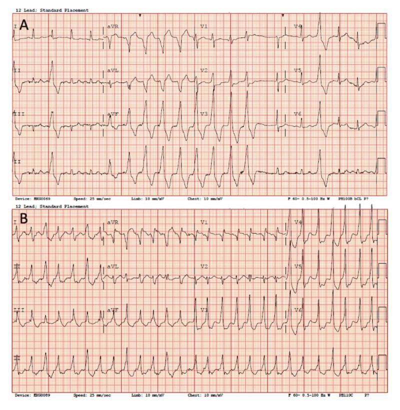 This diagnostic image displays two comparative 12-lead electrocardiograms (ECGs) representing wide-complex tachycardia localized to the ventricular outflow tract. Panel A illustrates a regular wide-complex rhythm characterized by an inferior axis and a QS pattern in leads aVR and aVL. The precordial transition is early, occurring before lead V3, which is a visual marker often associated with a left ventricular outflow tract (LVOT) origin. Panel B demonstrates a similar wide-complex tachycardia but with distinct morphological variations: it features a QR pattern specifically in lead V1, an inferior axis where the R-wave voltage ratio in lead II/III is greater than 1, and a precordial transition occurring at lead V3. These ECG findings are clinically significant for mapping the anatomical origin of idiopathic or post-surgical ventricular arrhythmias. The tracings are presented on standard grid paper (25 mm/sec) and serve as a comparative educational resource for identifying exit sites of ventricular tachycardia based on QRS morphology and axis transition.