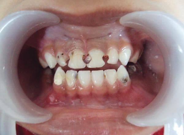 This clinical photograph shows a preoperative intraoral view of a pediatric patient (5-year-old male) using plastic cheek retractors to expose the primary dentition. The image demonstrates severe Early Childhood Caries (ECC). The upper central and lateral incisors (teeth 51, 52, 61, 62) exhibit extensive structural destruction, with significant loss of enamel and dentin on the mesial and distal proximal surfaces, appearing as deep, darkened carious lesions. Dark brown to black cavitation is visible, particularly between the central incisors. The lower anterior dentition displays relatively better alignment, though localized areas of discoloration and incipient carious lesions are present on the mandibular incisors and canines. The gingival tissues appear pink and generally healthy without significant recession, although localized inflammatory changes are visible near the severely decayed maxillary teeth. This image illustrates a typical clinical presentation of bottle-induced or early childhood caries requiring comprehensive restorative or endodontic intervention in a pediatric dentistry context.