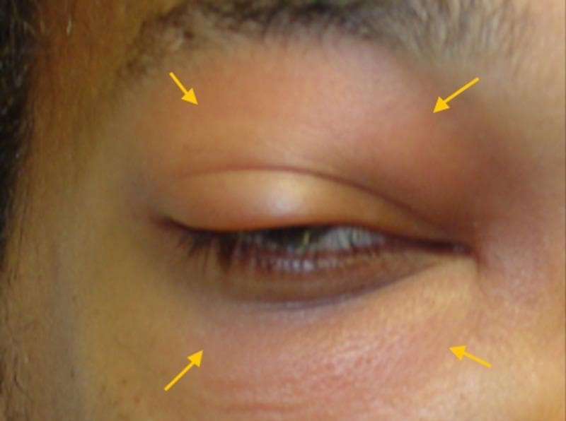 A clinical photograph of a patient's right eye and periorbital region illustrating acute inflammatory changes. The image demonstrates significant periorbital edema, characterized by prominent swelling of both the upper and lower eyelids, which narrows the palpebral fissure. Diffuse erythema is visible across the eyelid skin, extending towards the malar and frontal regions. There is a perceptible forward protrusion of the globe, consistent with proptosis. Yellow arrows are used to annotate the areas of maximal soft tissue swelling and inflammation. These clinical signs are hallmark indicators of orbital or preseptal cellulitis, frequently associated with underlying sinusitis or odontogenic infection. The image is intended for medical education to aid in the visual recognition of ocular emergencies and the differentiation between preseptal and orbital involvement based on the presence of proptosis.