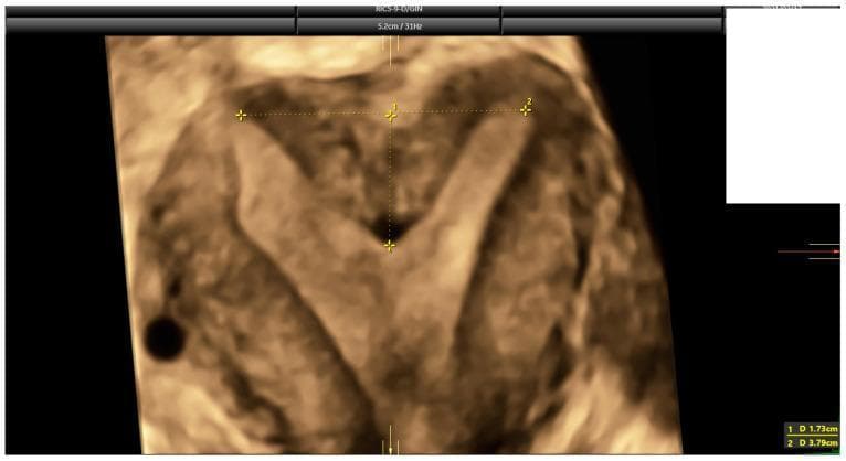This diagnostic image is a 3D ultrasound of the uterus in the coronal plane, specifically reconstructed to evaluate congenital uterine anomalies. The image demonstrates a septate uterus, characterized by a significant internal midline indentation of the uterine fundus that divides the upper endometrial cavity into two horns while maintaining a relatively flat or minimally indented external serosal contour. Caliper measurements are visible for diagnostic classification: marker '1' measures the fundal indentation depth at 1.73 cm (17.3 mm), and marker '2' measures the inter-cornual distance at 3.79 cm. These measurements are critical for applying diagnostic criteria such as ESHRE-ESGE, ASRM, and CUME to differentiate between septate, bicornuate, and arcuate uterine morphologies. The educational focus is on identifying internal cavity architecture and utilizing specific measurement thresholds (e.g., indentation >10-15mm) to classify Mullerian duct anomalies in reproductive medicine.