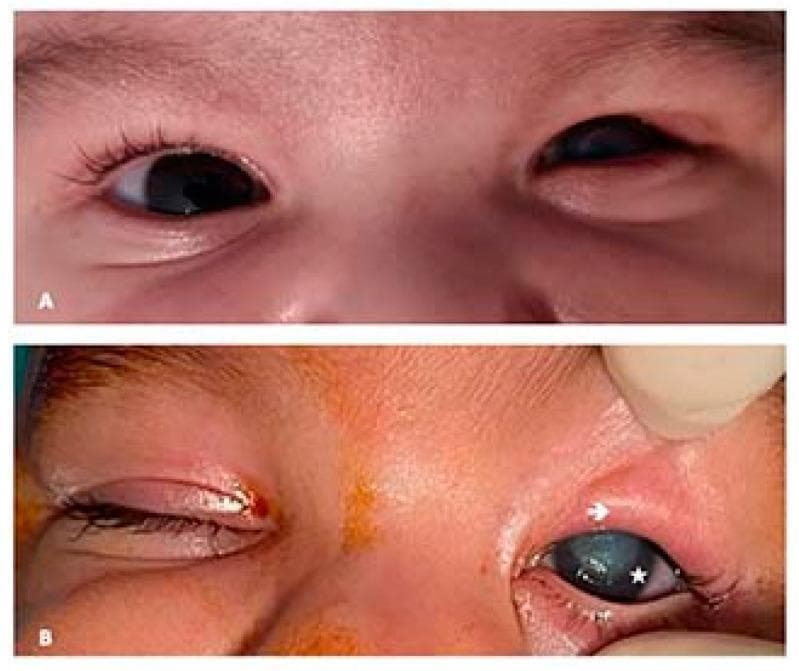 Two-panel clinical photograph (A and B) illustrating congenital upper eyelid entropion in a pediatric patient. Panel A shows the initial clinical presentation with the right eye appearing normal and the left upper eyelid exhibiting inward rotation. Panel B shows a preoperative view with annotations. The upper eyelid of the left eye demonstrates severe entropion, with an arrow indicating hypertrophy of the upper pretarsal orbicularis muscle. The ciliary margin shows a notable absence of cilia (eyelashes) due to chronic irritation or congenital defect. A star marks a central corneal leucoma (opacification) on the left eye, which is a secondary complication resulting from the persistent inward turning of the eyelid and subsequent corneal rubbing. This image serves as a clinical reference for pediatric ophthalmology, highlighting the diagnostic features of primary upper eyelid entropion and its associated corneal pathology.