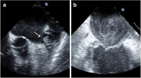 This diagnostic image consists of two panels (a and b) showing transesophageal echocardiogram (TEE) views of the heart, specifically focusing on the left atrium (LA) and left atrial appendage (LAA). Panel (a) demonstrates a left atrial appendage thrombus, identified by the white arrow. The thrombus appears as a discrete, echo-dense, circumscribed intracavitary mass clearly separated from the underlying endocardium and pectinate muscles. Panel (b) illustrates left atrial spontaneous echo contrast (SEC), frequently referred to as 'smoke.' This is characterized by hazy, swirling, cloud-like echoes within the atrial chamber that represent blood stasis and an increased risk for thromboembolism. These images are clinically significant for the evaluation of stroke risk in patients with atrial fibrillation or structural heart disease, highlighting the visual distinction between a formed solid thrombus (a) and the dynamic precursor state of spontaneous echo contrast (b).