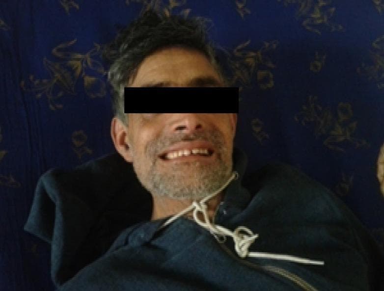 Clinical photograph of an adult male patient demonstrating risus sardonicus, a hallmark sign of generalized tetanus. The image shows a frontal view of the face where sustained contraction of the facial musculature, specifically the zygomatic and buccinator muscles, results in a characteristic abnormal, grimacing smile. The corners of the mouth are pulled laterally and upwards, and the teeth are partially bared due to involuntary spasm. This fixed facial expression, also known as 'sardonic grin,' is a pathological indicator of the tetanospasmin toxin's effect on the nervous system, leading to hypertonia and muscle spasms. The patient is depicted in a supine position, showing fair skin and dark hair. This visual serves as a primary diagnostic reference for clinical neurology and infectious disease, illustrating the involuntary muscle hyperactivity associated with Clostridium tetani infection.