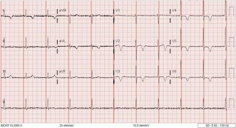 This diagnostic image is a standard 12-lead electrocardiogram (ECG) displayed on a traditional grid layout. The tracing shows a normal sinus rhythm with a heart rate of approximately 75-80 bpm. The QRS complexes exhibit normal duration and a standard R-wave progression across the precordial leads (V1-V6). The most prominent diagnostic feature is the presence of deep, symmetric T-wave inversions in the anterolateral leads, specifically V2 through V6, as well as lead aVL. There is a notable resolution of previously reported ST-segment elevation, with the ST segments now appearing largely isoelectric. These findings are clinically significant as they often represent a post-ischemic state or reperfusion following transient coronary vasospasm, such as Prinzmetal's angina. The limb leads (I, II, III, aVR, aVL, aVF) show upright T waves except in aVR (where inversion is physiological) and aVL. This ECG serves as an educational example of dynamic T-wave changes and the resolution of injury patterns in the context of acute coronary syndromes or vasospastic disorders.