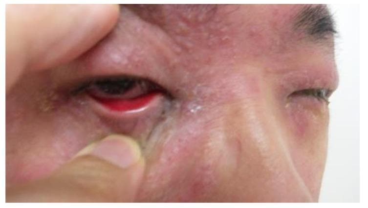 This clinical photograph shows a close-up view of a patient presenting with binocular conjunctivitis. The primary visual finding is severe, diffuse conjunctival injection (redness) and significant swelling of the eyelids (blepharedema) in both eyes. In the patient's right eye (viewer's left), the lower eyelid is manually retracted, revealing deep erythema of the palpebral conjunctiva and possible chemosis. Mucopurulent or watery discharge is visible along the lid margins and inner canthus. The surrounding periocular skin exhibits erythema and a textured, papular appearance, suggesting associated dermatitis or an allergic component such as atopic keratoconjunctivitis (AKC). The educational focus of this image is the clinical presentation of bilateral ocular inflammation, highlighting the key diagnostic signs of conjunctival hyperemia, lid edema, and ocular discharge essential for distinguishing between viral, bacterial, and allergic conjunctivitis.